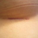 Incision - looking really good (I think).  :)