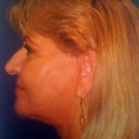 taken at LSL 8 weeks after no make up