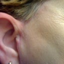 taken Mar 19 2011 no makeup 2 inches away from ears right ear.11 months after