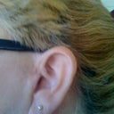 Mar 19 2011 left ear 11 months after surgery you can clearly see I do not have 5 inch scars down my face & I never did