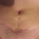 3 weeks post op close up