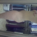 Side view two weeks before surgery