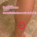 Waiting to get this one removed. It was in the way due to leg compression cuffs, so we decided to do it in the office