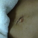 On day of surgery pre op
