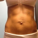 2 months post op, looks gross