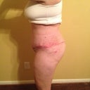 Post Op 15 - left side