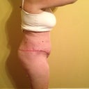 Post Op 15 - right side