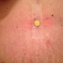 Post Op 15 - Belly Button with ear plug - LOL!