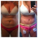 BEFORE & post op day 2