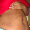 1 month before Pre-op Picture