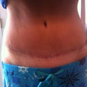 7 weeks PO with silicone strip