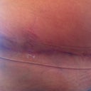 7 weeks PO with silicone strip
