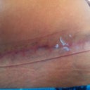 7 weeks PO with silicone strip