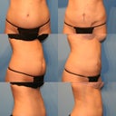 Day of surgery and 6 months later. They did not send me pics turned to the other side where the tool sucked a little too much fat out. But still a positive turn out!