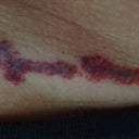 right after 3rd treatment