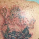 right after 3rd treatment