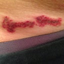 3rd treatment day 2