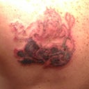 3rd treatment day 2