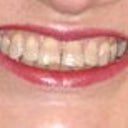Before picture, sorry its blurry from enlarging it... but you can see the color and the chips on the bottom of my front teeth