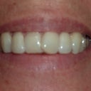 3 buttons on my side teeth and my 2nd invisalign tray in -