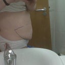 Look at that horrible overhang! Marked up, ready for the op.
