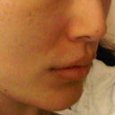 before filler in lips