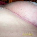 Post op week 7.  The scar--does't look to bad.