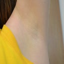 I've had my 4th treatment about 2 weeks ago, and have not shaved in at least a month. Sorry there is no before photo. Previously I could only wear sleeveless the day I shaved and the day after, and then my underarm hair became noticeable, but I was unable to shave again for a while due to sensitivity.