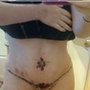 1 week post opp. the red stuff is tape. (not scar)