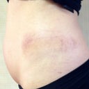 Side Bruises!  Will post more pictures when I see results.