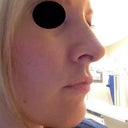 DAY THAT FINAL TAPING AND SUTURES WERE REMOVED