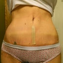 Day 24 PO with my silicone scar strips on