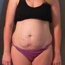 Pre- Surgery front