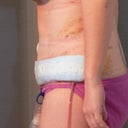5 days post-op side