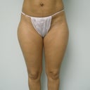FRONT: PRE OP