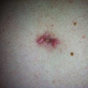 hypertrophic BB scar- being revised tomorrow!!
