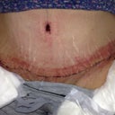 Incision