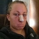 Day two. Much more swollen