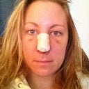 Day four. Less swollen. Still pretty bruised
