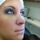 Day seven. Removed stitches and brace, put on the tape. Nose is still very swollen