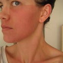6.5 days since fraxel Re:pair.  Almost all the major swelling is gone, still red and still using aquaphor.