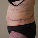 Day 2 side check out the bruise going down the leg.