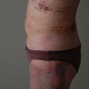 Week 1 side. Horrible bruise. Other side is not as bad.