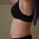 Week 2 side. Bruise on leg is still there, but abdomen area looks better.