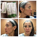Before treatment