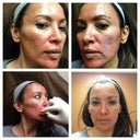 immediately after treatment