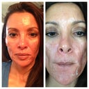 day 3, afternoon.  peeling has started.  21 November 12