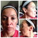 day 5, peeling is really showing here.  no itching though. 23 Nov 12
