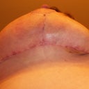 2weeks post-op, underside of right breast