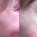 Before and after, you can see my skin was smooth before and "textured" after.